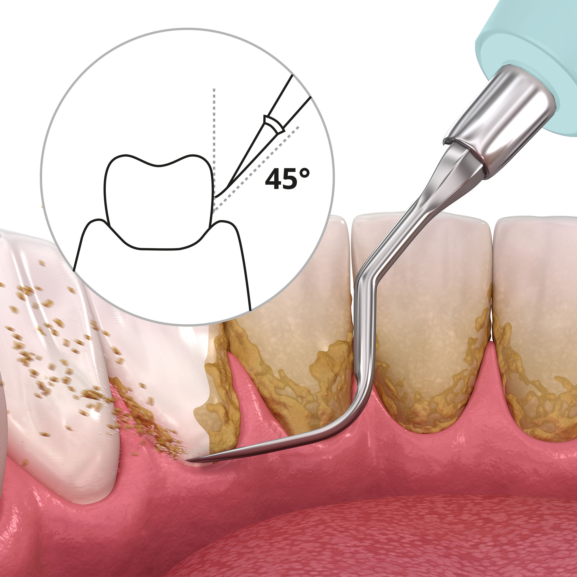 Proceso de limpieza dental con herramienta. Dientes con placa. Primer plano y diagrama.