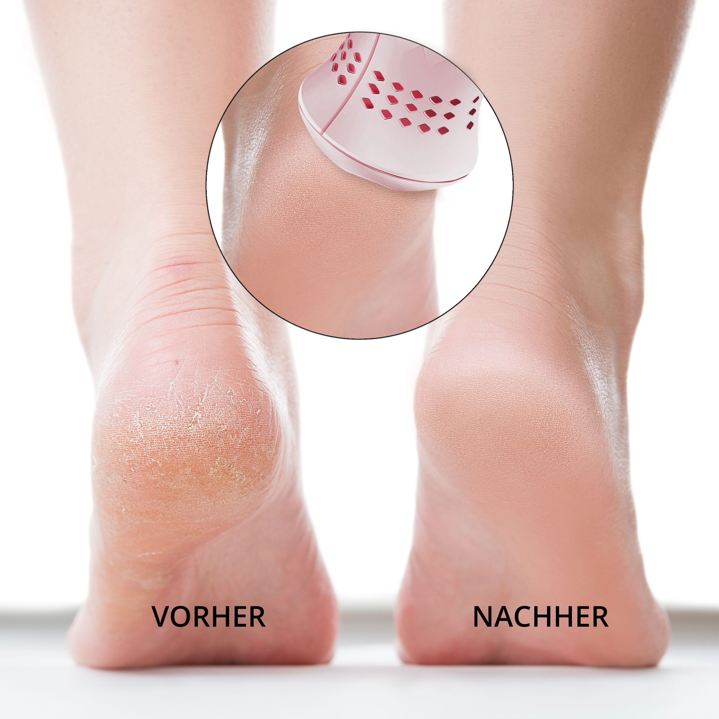 Vue avant-après des talons, montrant un appareil de soin des pieds.