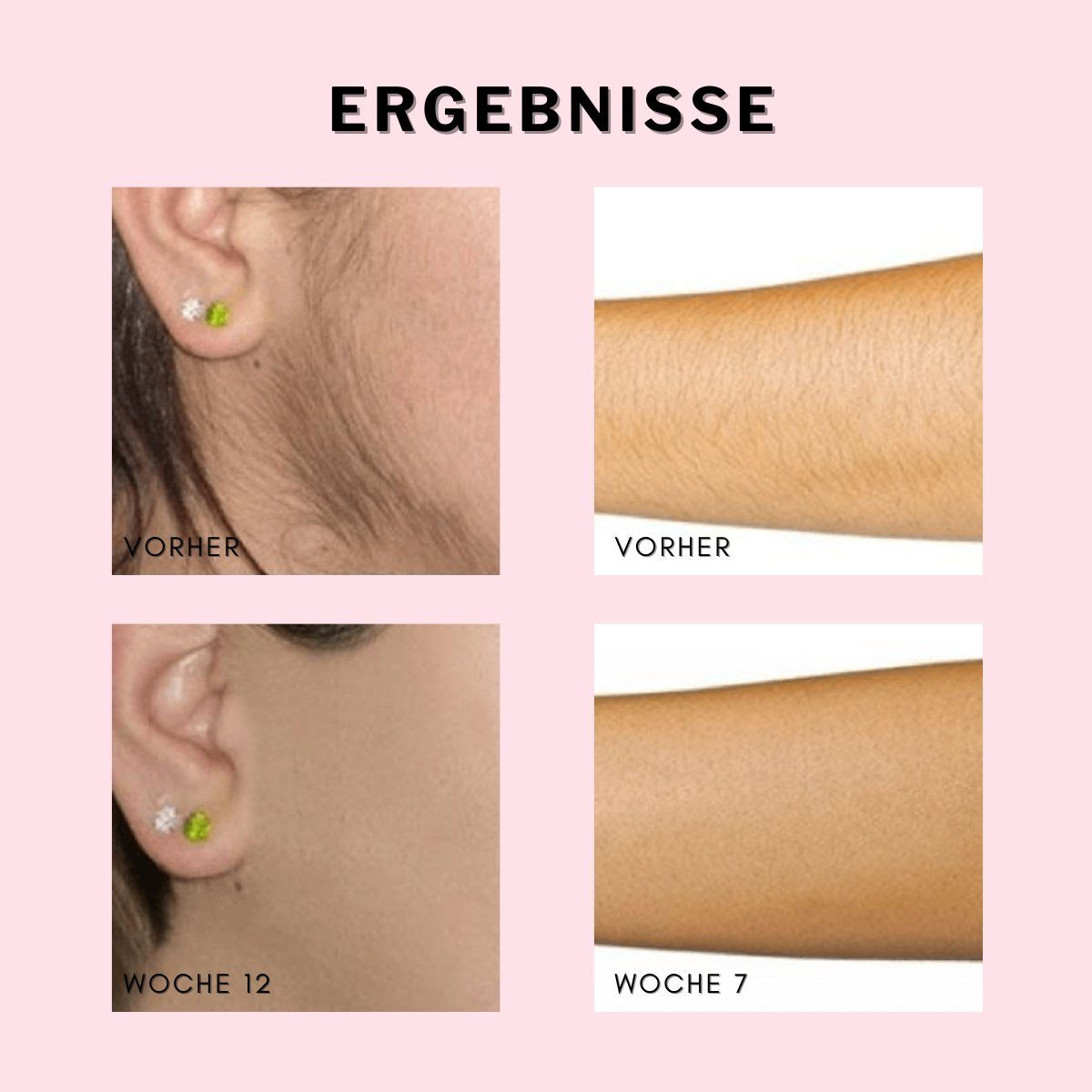 Vorher-Nachher-Ergebnisse der Haarentfernung an Ohr und Arm, rosa Hintergrund.