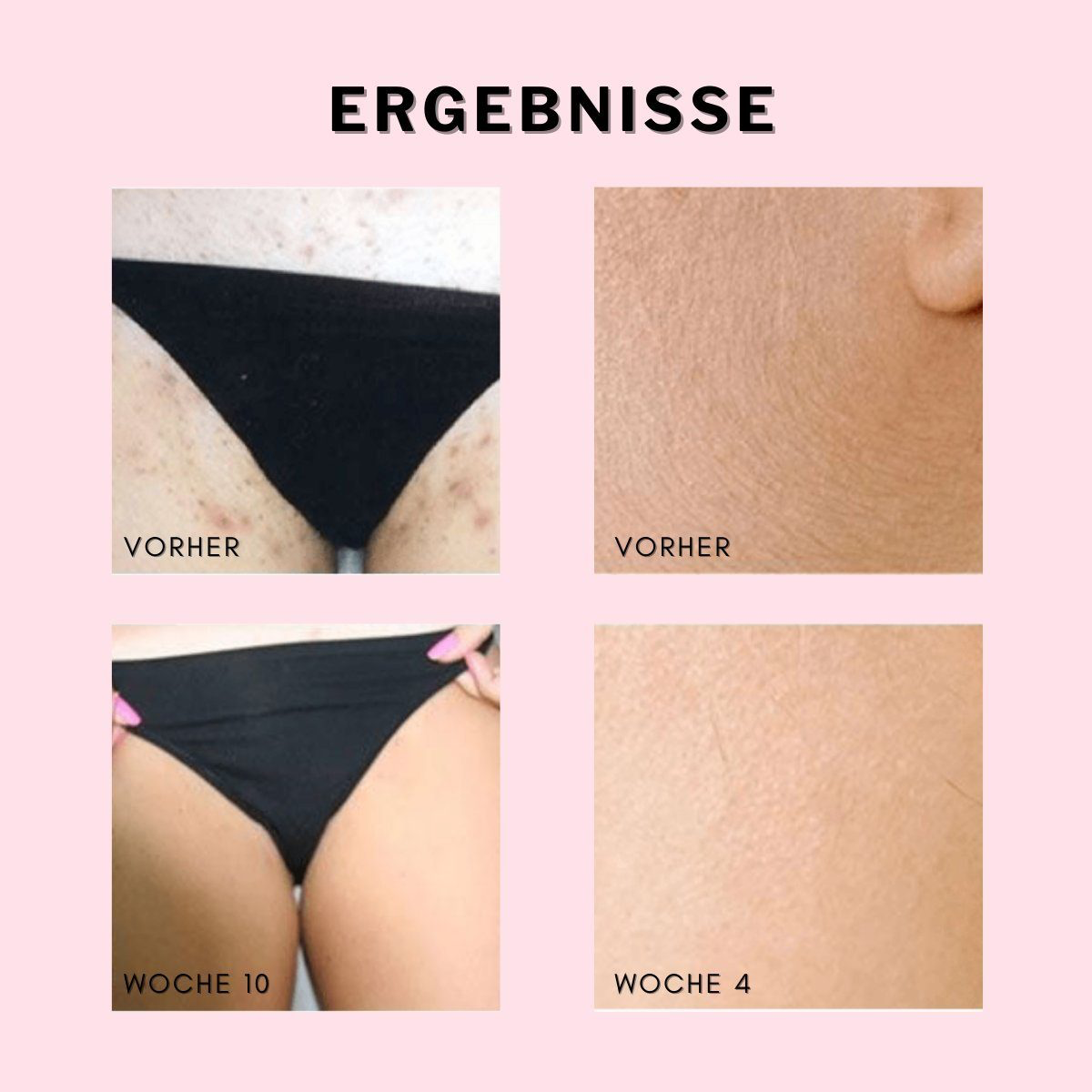 Vier Bilder zeigen Vorher-Nachher-Verbesserungen des Hautzustands über Wochen.