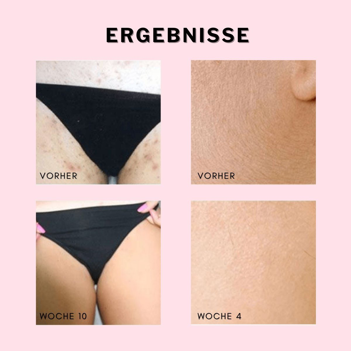 WEIß Laser IPL Pro Haarentferungsgerät WONDERSKIN (2 Modi) Haarentfernung