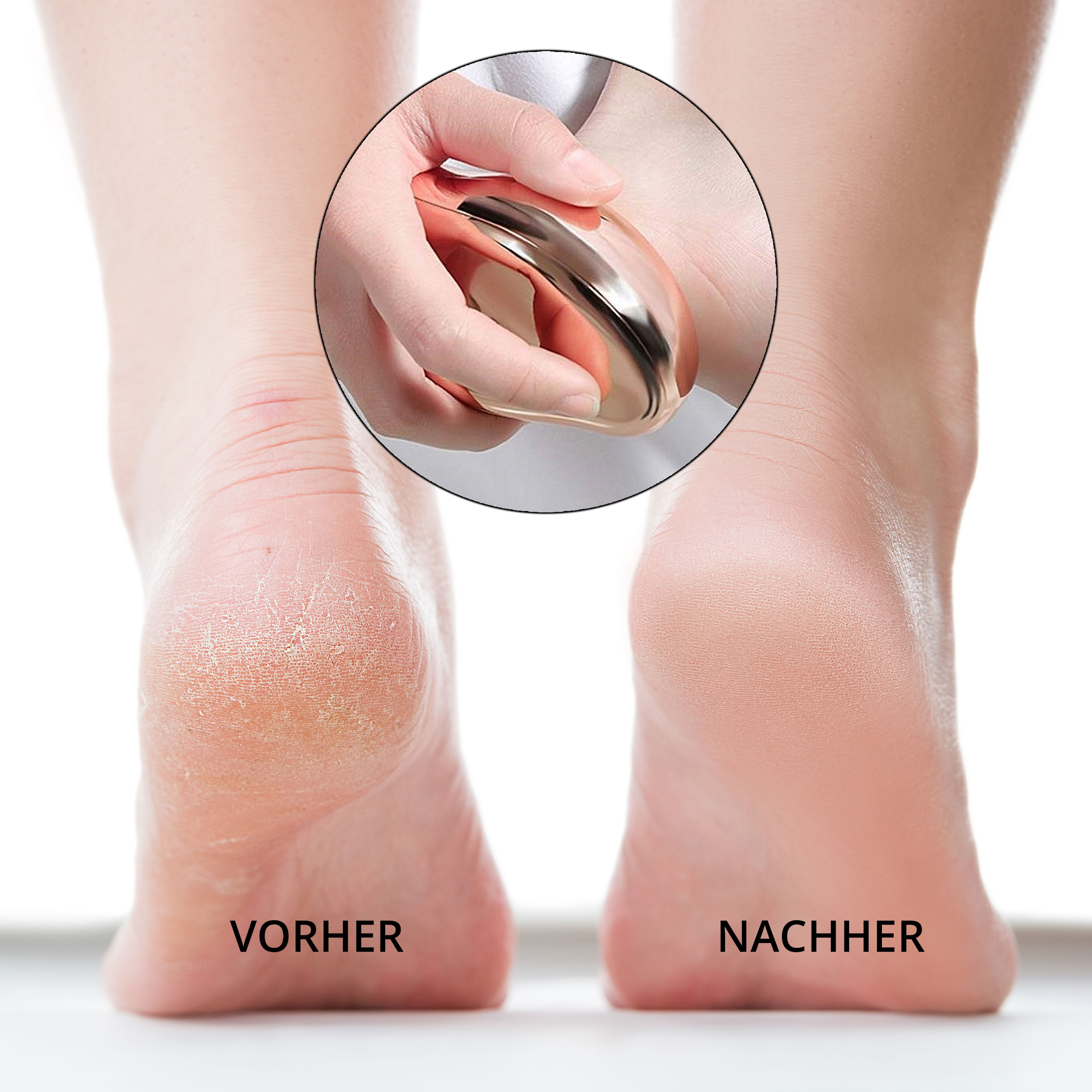 Fuß mit rissiger Ferse vor und nach der Behandlung mit einem Fußpflege-Werkzeug.