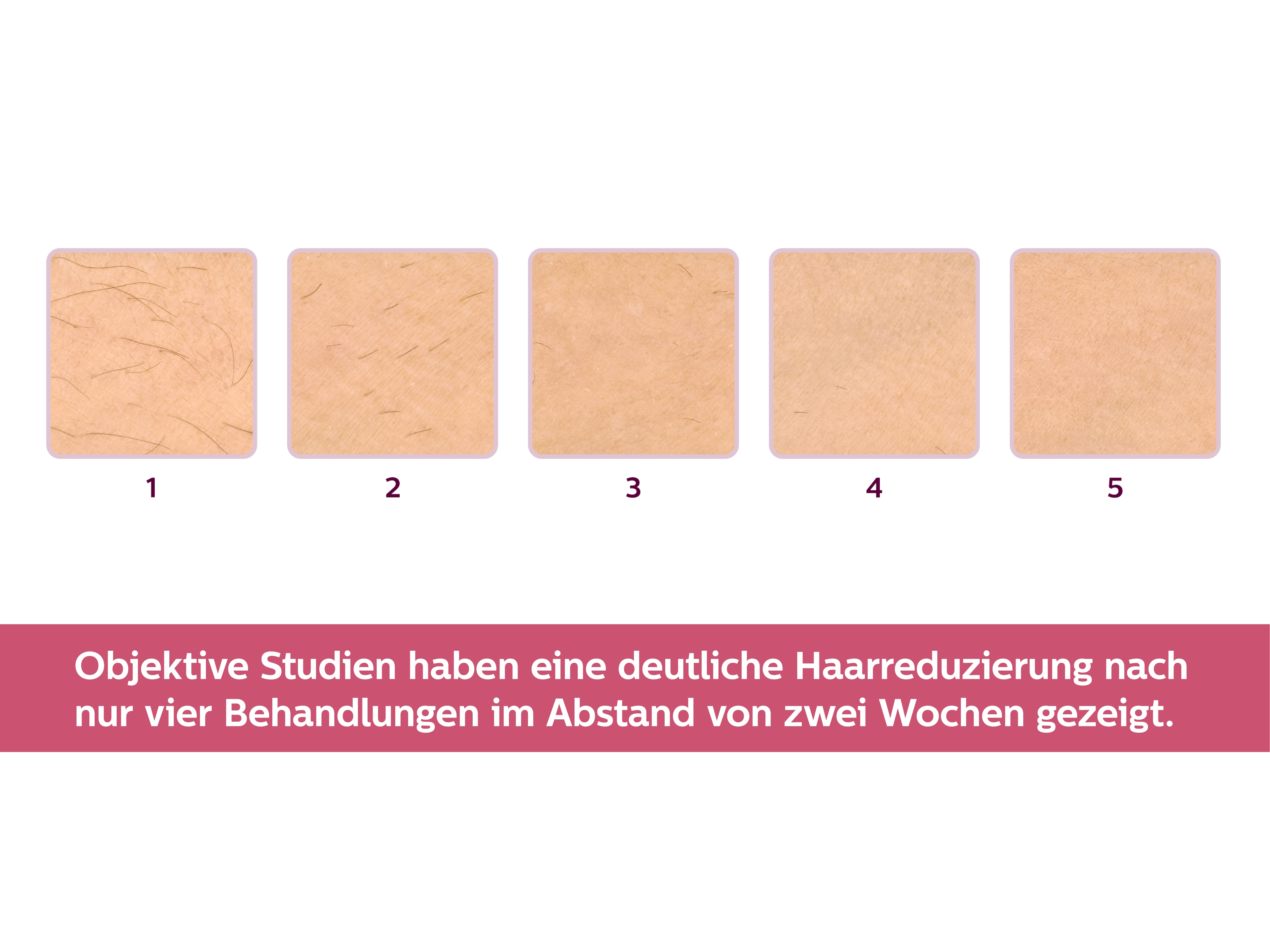 PHILIPS Lumea Prestige IPL-Haarentfernungsgerät BRI956/00, weiß-rosegold IPL-Haarentfernungsgerät (weiß, roségold, mit , )